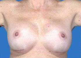 BREAST RECONSTRUCTION WITH IMPLANTS: CASE L14 After