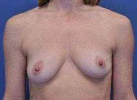 BREAST RECONSTRUCTION WITH IMPLANTS: CASE L15 Before