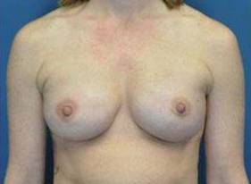 BREAST RECONSTRUCTION WITH IMPLANTS: CASE L15 After