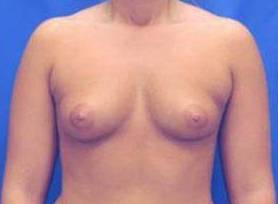 BREAST RECONSTRUCTION WITH IMPLANTS: CASE L16 Before
