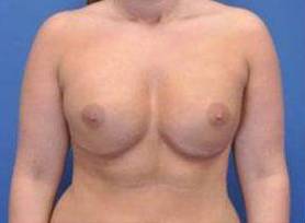 BREAST RECONSTRUCTION WITH IMPLANTS: CASE L16 After