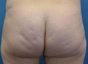Cellulite Reduction : Case F23 Before