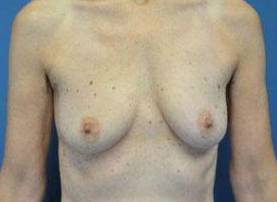 BREAST RECONSTRUCTION WITH IMPLANTS: CASE L22 Before