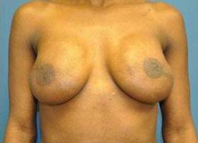 BREAST RECONSTRUCTION WITH IMPLANTS: CASE L26 After