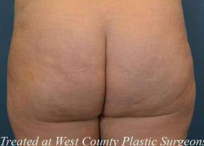 Cellulite Reduction : Case F23 After