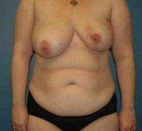BREAST RECONSTRUCTION WITH YOUR OWN TISSUE: CASE M1 Before