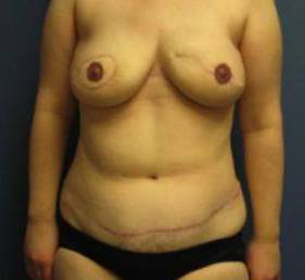 BREAST RECONSTRUCTION WITH YOUR OWN TISSUE: CASE M1 After