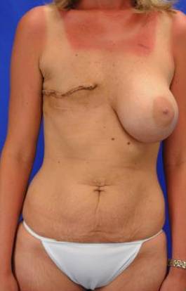 BREAST RECONSTRUCTION WITH YOUR OWN TISSUE: CASE M3 Before