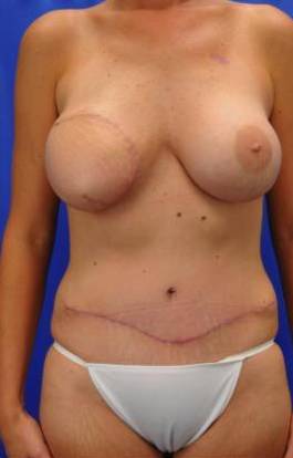 BREAST RECONSTRUCTION WITH YOUR OWN TISSUE: CASE M3 After