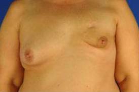 BREAST RECONSTRUCTION WITH YOUR OWN TISSUE: CASE M4 Before
