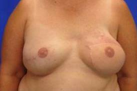 BREAST RECONSTRUCTION WITH YOUR OWN TISSUE: CASE M4 After