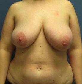 BREAST RECONSTRUCTION WITH YOUR OWN TISSUE: CASE M5 Before