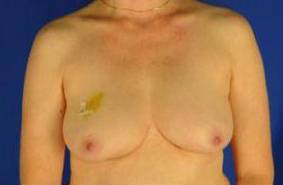 BREAST RECONSTRUCTION WITH YOUR OWN TISSUE: CASE M7 Before