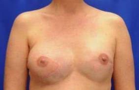 BREAST RECONSTRUCTION WITH YOUR OWN TISSUE: CASE M7 After