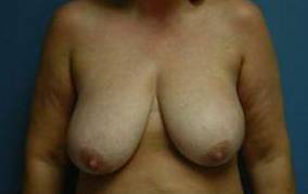 BREAST RECONSTRUCTION WITH YOUR OWN TISSUE: CASE M8 Before
