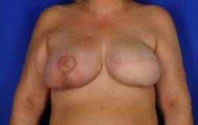 BREAST RECONSTRUCTION WITH YOUR OWN TISSUE: CASE M8 After
