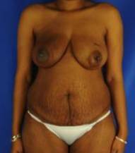 BREAST RECONSTRUCTION WITH YOUR OWN TISSUE: CASE M9 Before