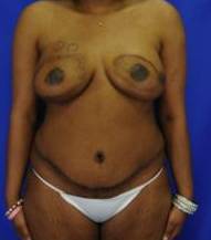 BREAST RECONSTRUCTION WITH YOUR OWN TISSUE: CASE M9 After