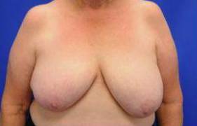 BREAST RECONSTRUCTION WITH YOUR OWN TISSUE: CASE M10 Before