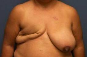 BREAST RECONSTRUCTION WITH YOUR OWN TISSUE: CASE M15 Before