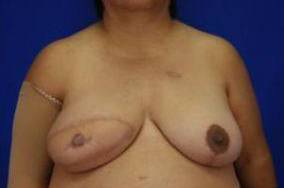 BREAST RECONSTRUCTION WITH YOUR OWN TISSUE: CASE M15 After