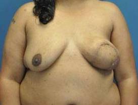 BREAST RECONSTRUCTION WITH YOUR OWN TISSUE: CASE L24 Before