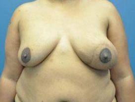 BREAST RECONSTRUCTION WITH YOUR OWN TISSUE: CASE L24 After