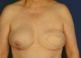 BREAST RECONSTRUCTION WITH YOUR OWN TISSUE: CASE M16 Before