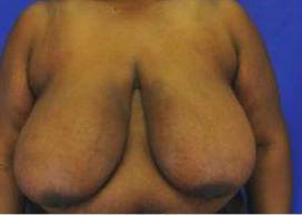 BREAST REDUCTIONS: CASE BRD8 Before