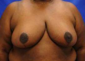 BREAST REDUCTIONS: CASE BRD8 After