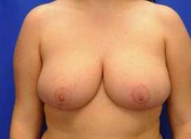 BREAST REDUCTIONS: CASE BRD2 After