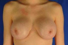CORRECTIVE BREAST SURGERY: CASE C1 Before