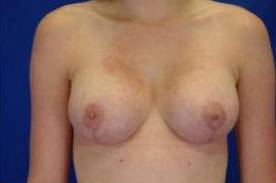 CORRECTIVE BREAST SURGERY: CASE C1 After