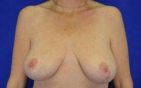 CORRECTIVE BREAST SURGERY: CASE C2 Before