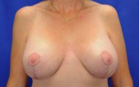 CORRECTIVE BREAST SURGERY: CASE C2 After