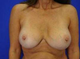 CORRECTIVE BREAST SURGERY: CASE C3 After