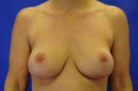 CORRECTIVE BREAST SURGERY: CASE C4 After
