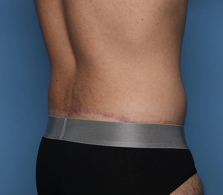 Rear Right View After thumbnail