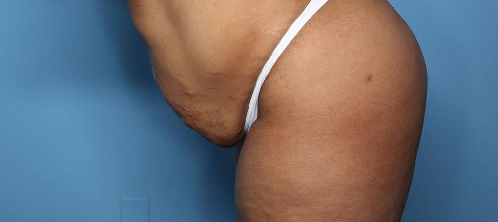 Left Lean View Before thumbnail