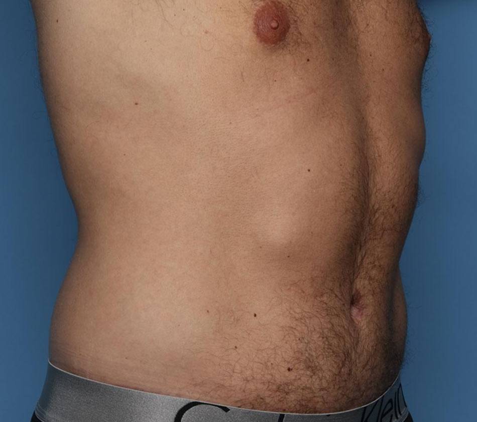 3/4 Right View After thumbnail