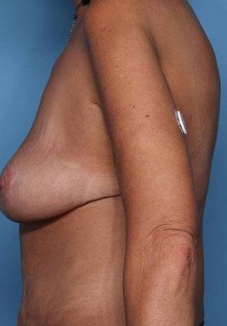 Left Side View After thumbnail