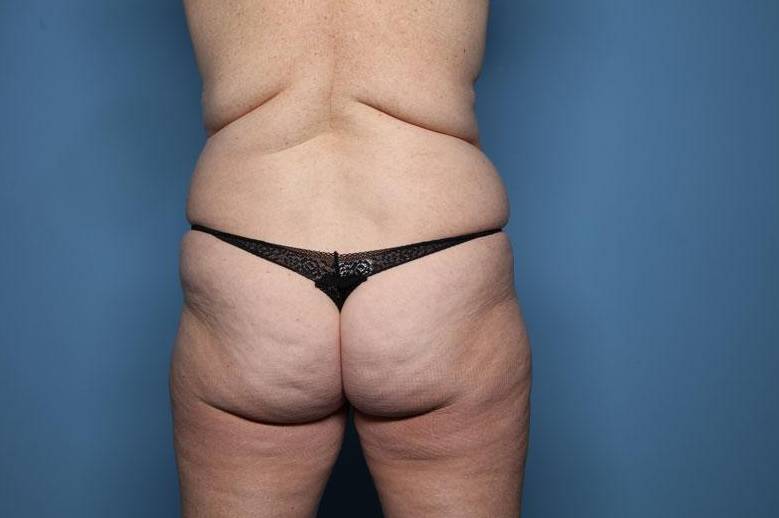 Rear View Before thumbnail