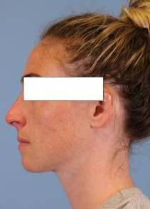 Left Side View After thumbnail