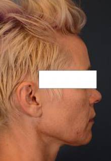 Right Side View Before thumbnail