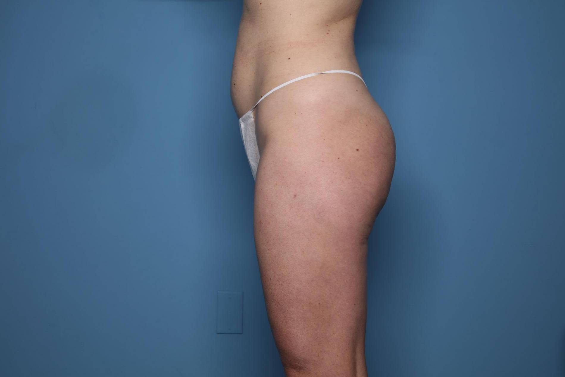 Left Side View Before thumbnail