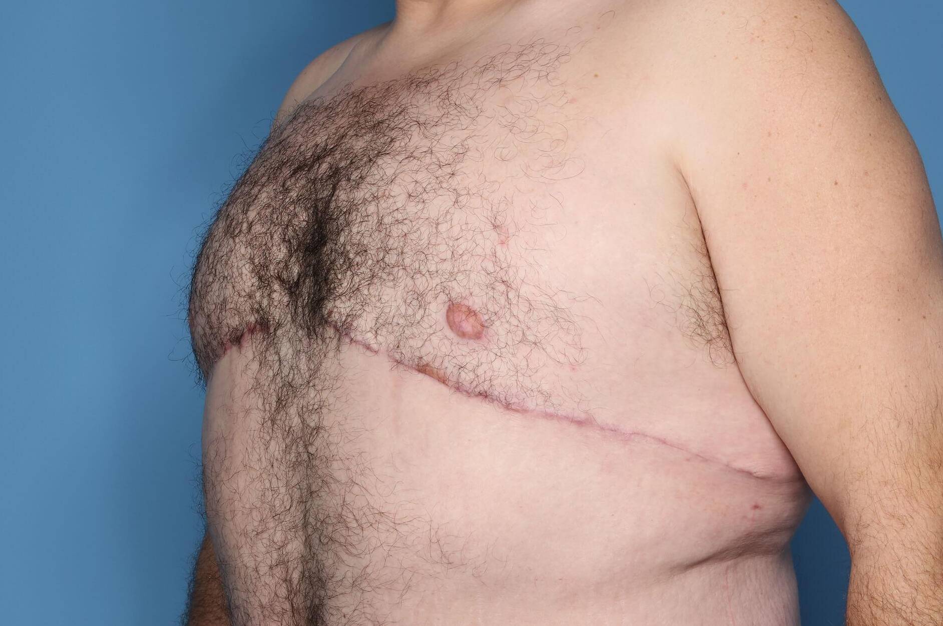 3/4 Left View After thumbnail
