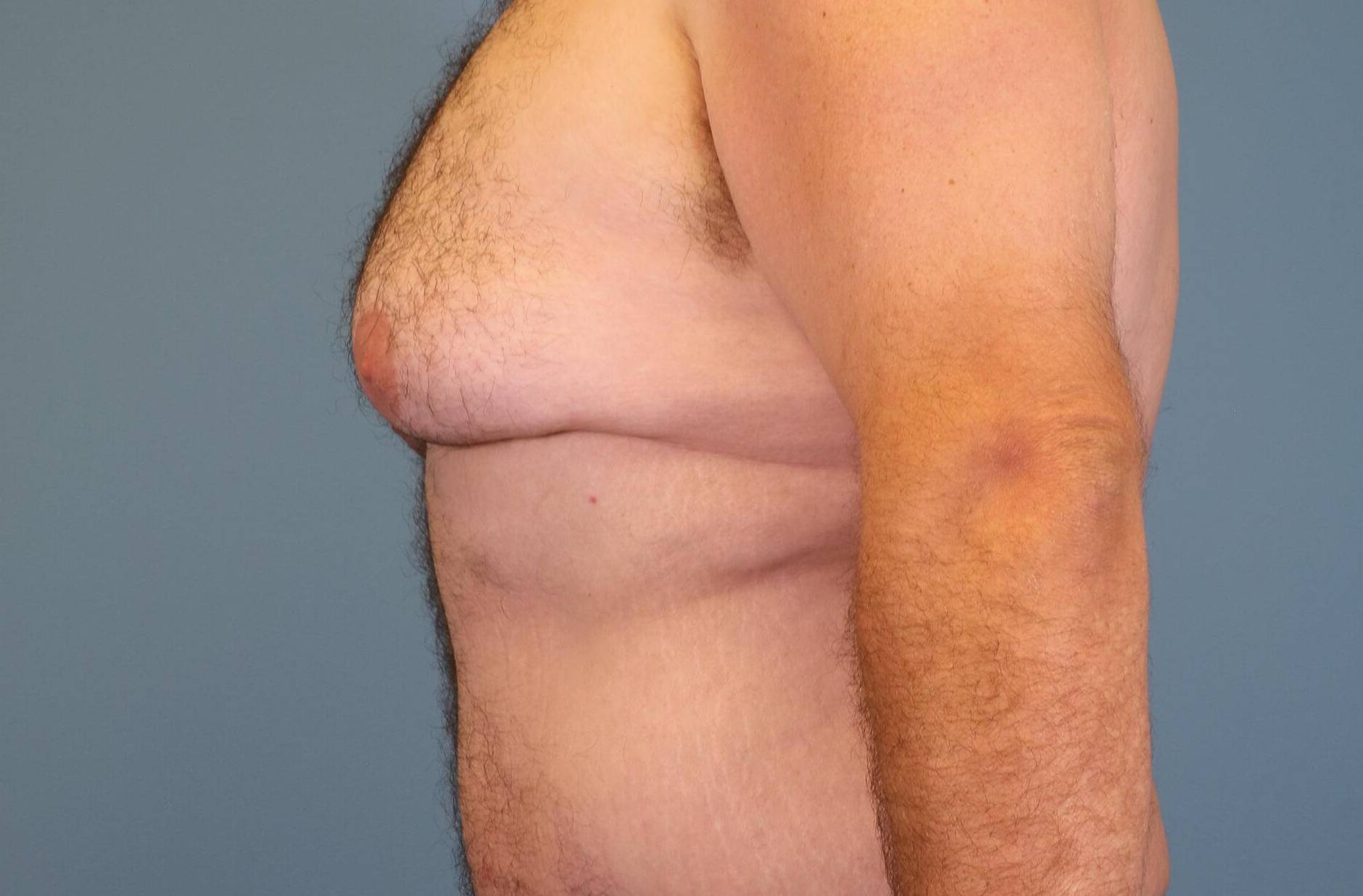Left View Before thumbnail
