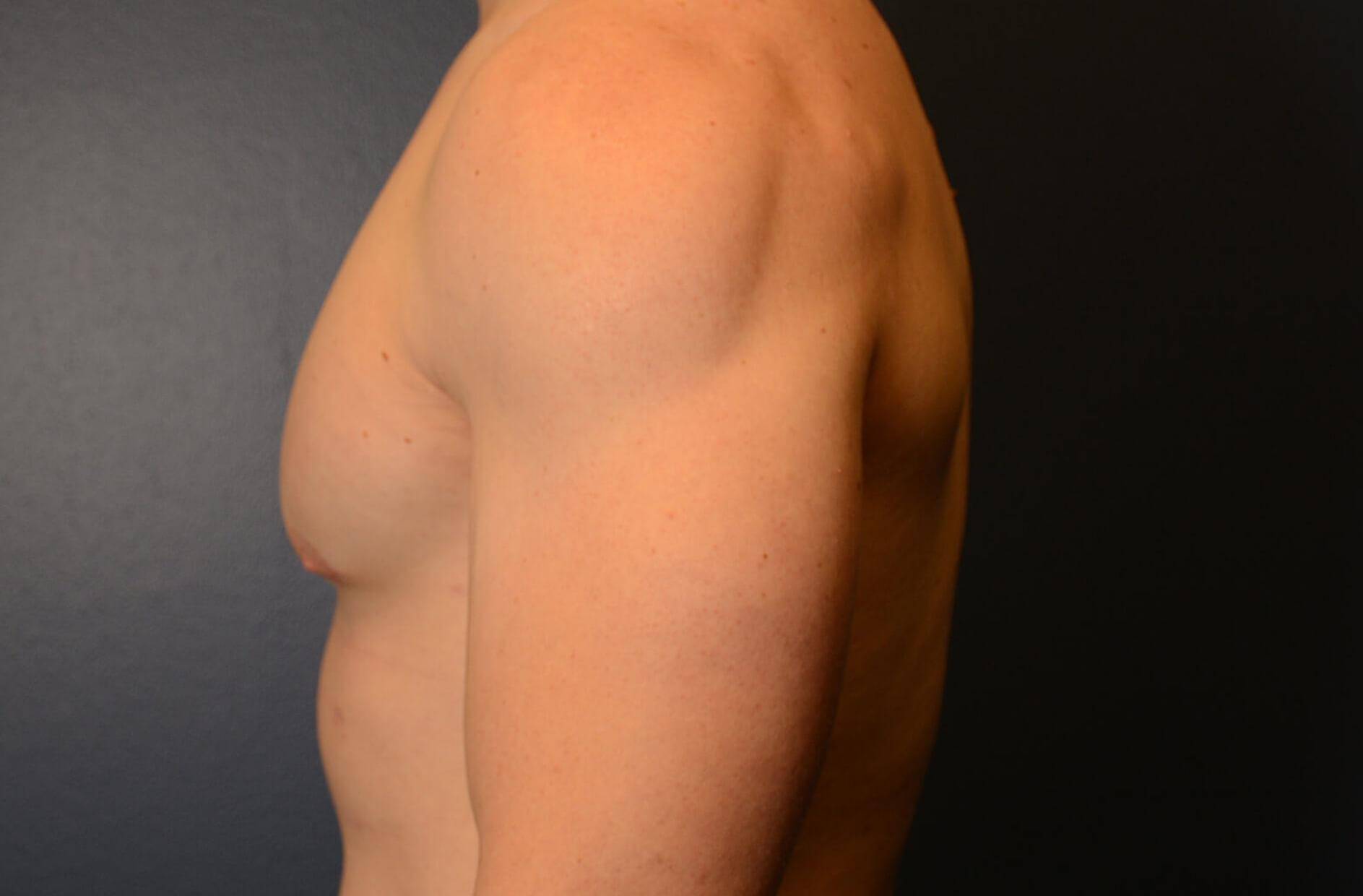 Left View Before thumbnail