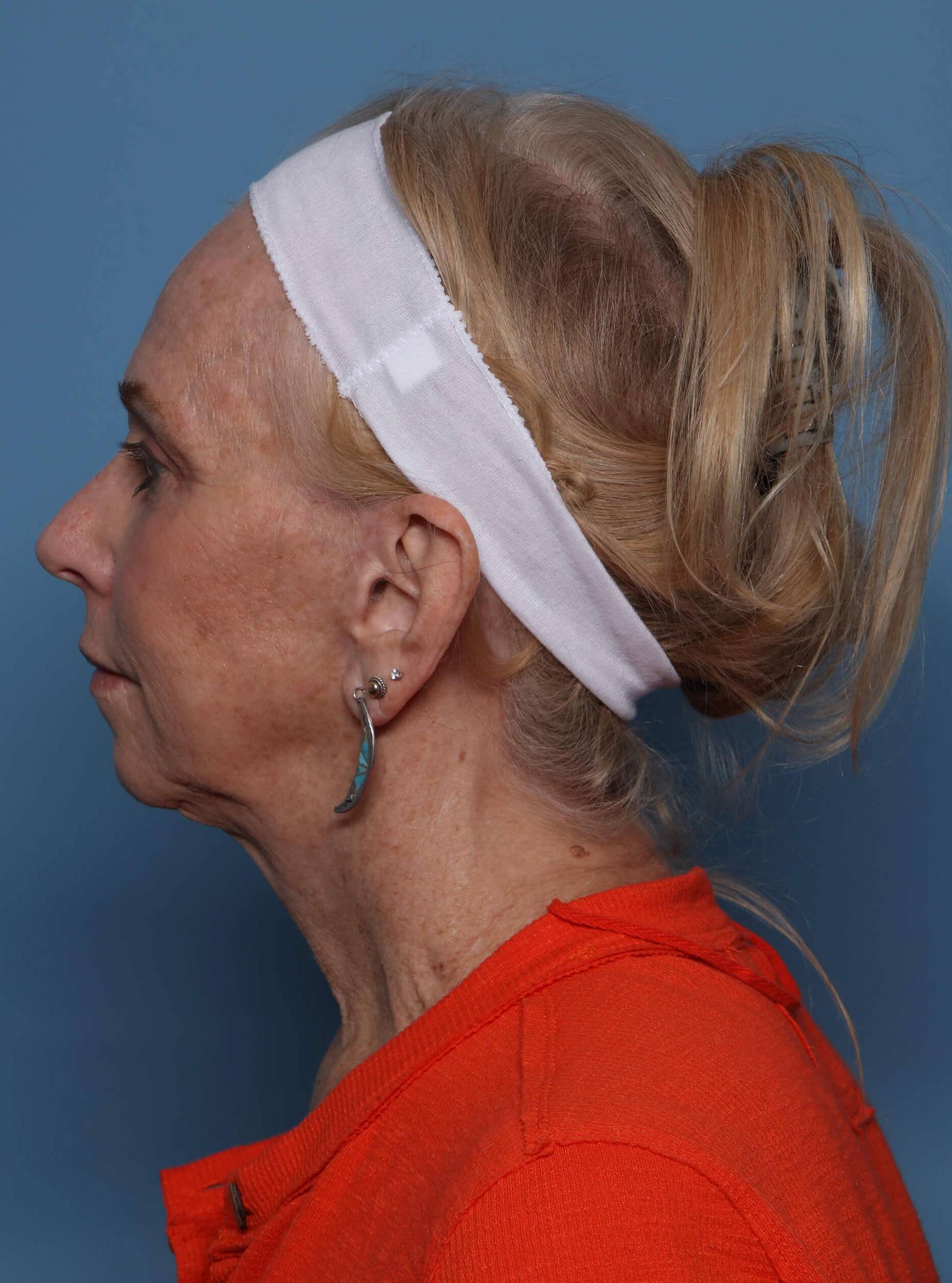 Side View Left After thumbnail