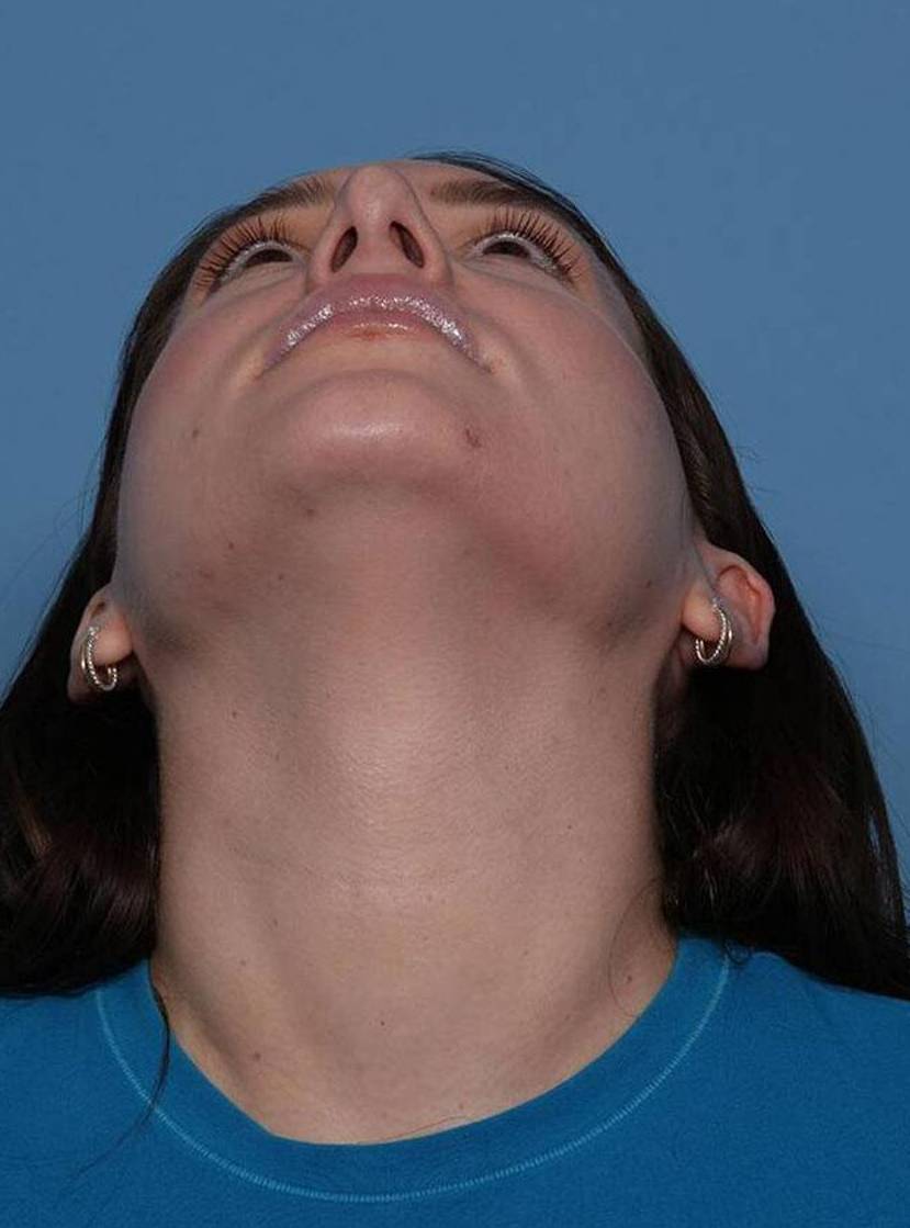 Chin View After thumbnail
